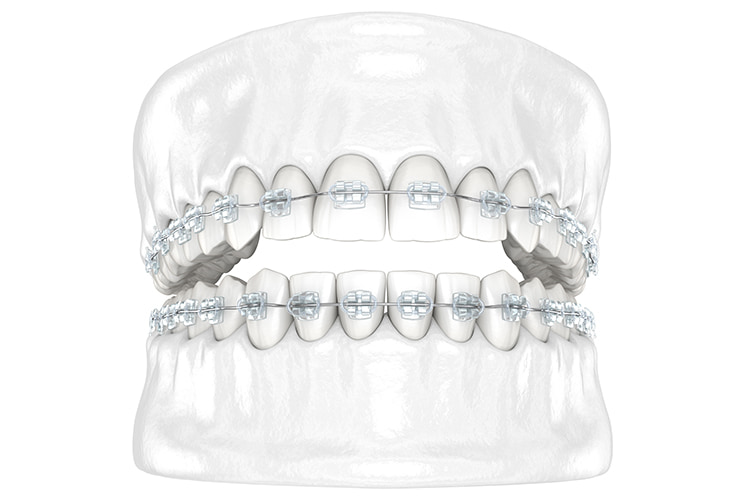 セラミックブラケット・ホワイトワイヤー