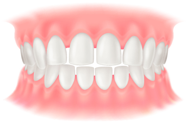 空隙歯列(くうげきしれつ)