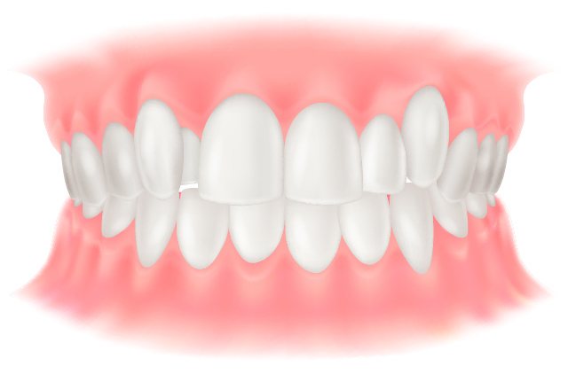 叢生(そうせい)