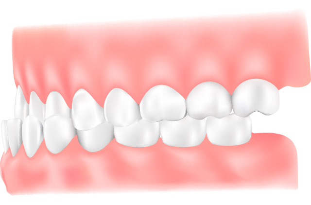 下顎前突(かがくぜんとつ)